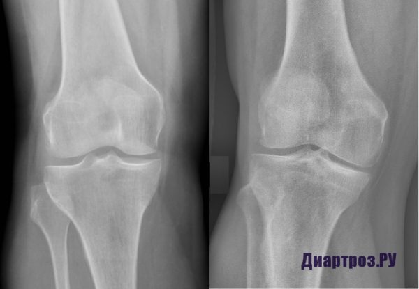 Артроз коленного сустава 1 степени на рентгеновском снимке