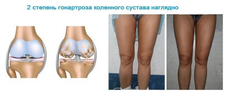 Деформирующий артроз коленного сустава: симптомы, лечение 1, 2, 3 ...