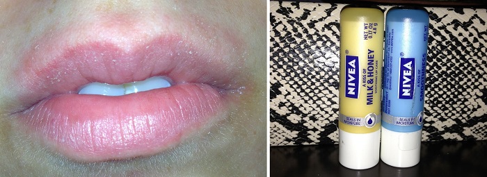 Аллергия кожи губ на бальзам для губ