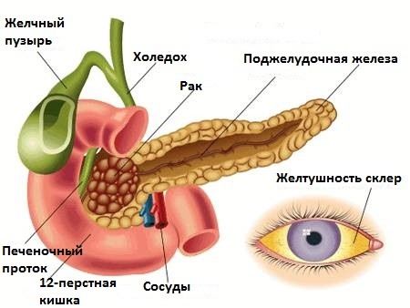 Механическая желтуха при раке поджелудочной