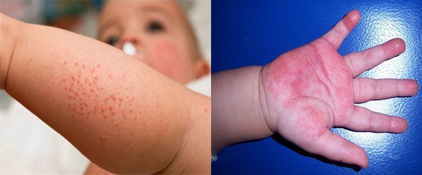 проявление аллергии на мороз у ребенка