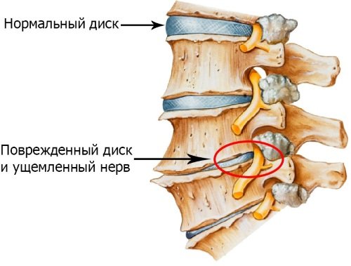 Дегенеративно – дистрофические изменения в области позвоночника