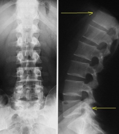 Остеохондроз поясницы на рентгеновском снимке