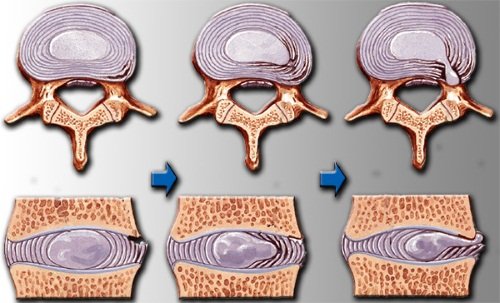Этапы развития остеохондроза