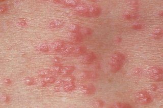 Red spots on the skin caused by scabies