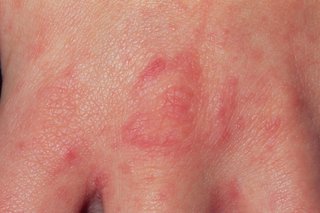 A scabies rash on the hand