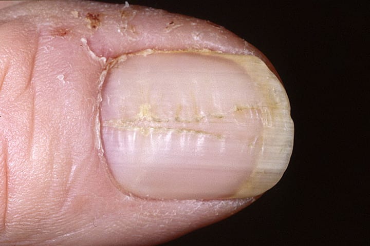 дистрофия ногтей