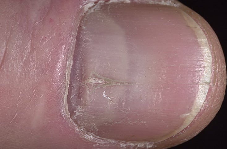 дистрофия ногтевой пластины