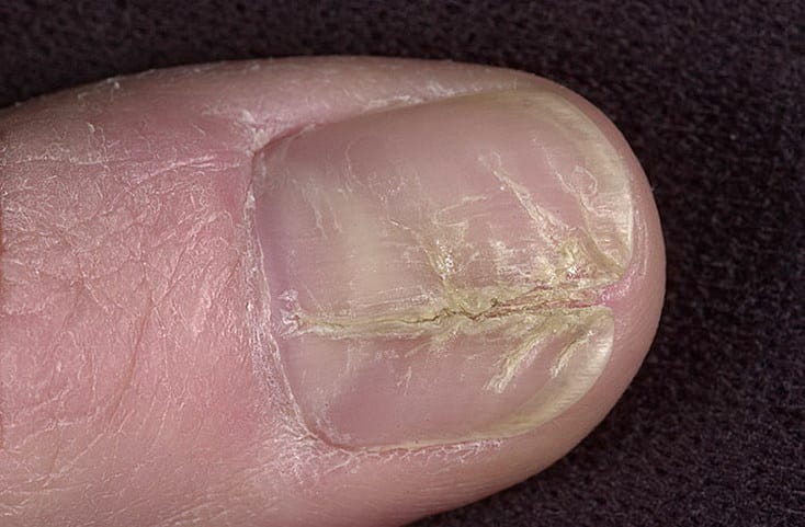 дистрофия ногтевой пластины