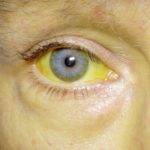 Гемолитическая желтуха у взрослых: симптомы и лечение