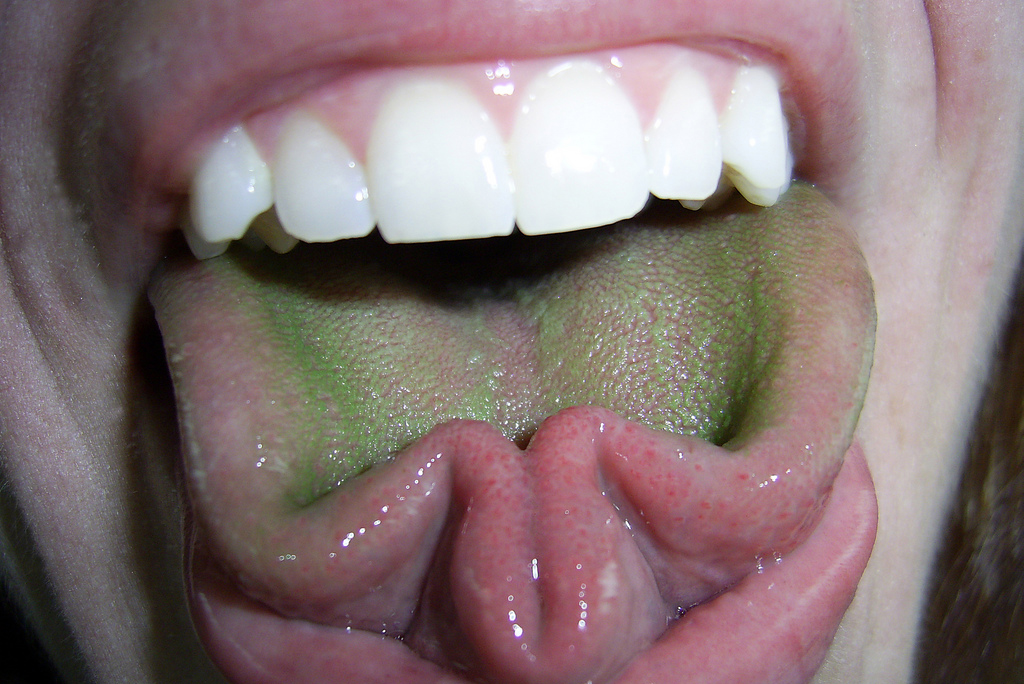 Зеленый налет на языке