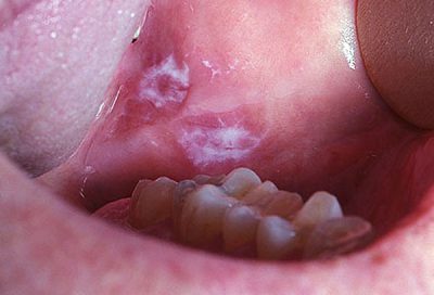 Лейкоплакия полости рта