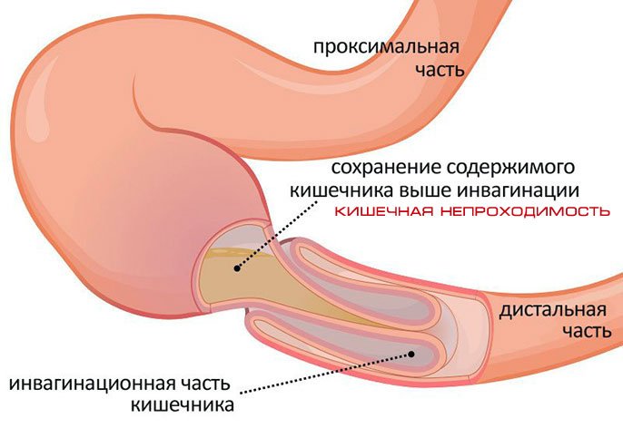 непроходимость кишечника