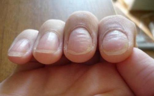 волнистые ногти