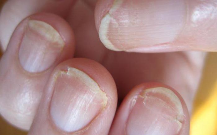 дистрофия ногтя лечение