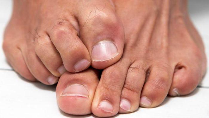 дистрофия ногтей на ногах