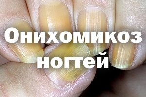 Желтые ногтевые пластины