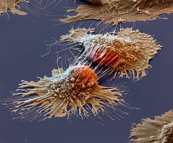 Раковая опухоль под микроскопом
