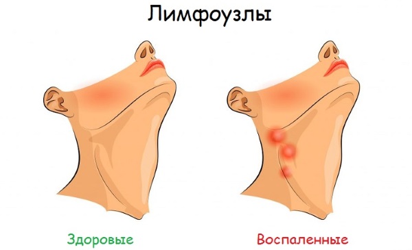 Причины и лечение воспалённых лимфоузлов на шее, если увеличенные, болят, опухли. УЗИ, диагностика и удаление