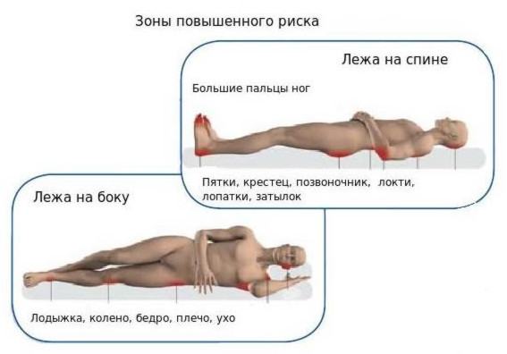 Самые частые места образования пролежней