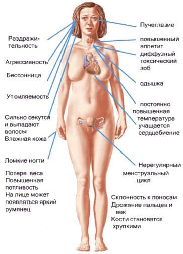 Симптомы гипертиреоза