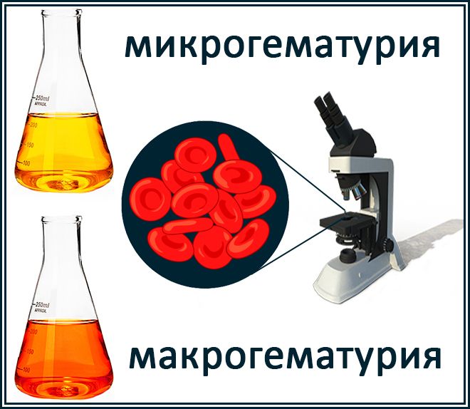 микрогематурия макрогематурия