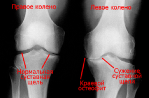 Рентген коленного сустава для выявления патологии