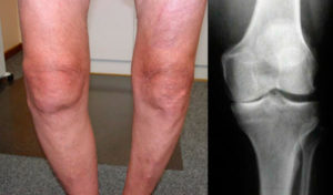 Артроз коленного сустава 2 степени