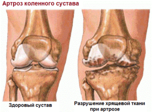 Артроз первой степени коленного сустава 