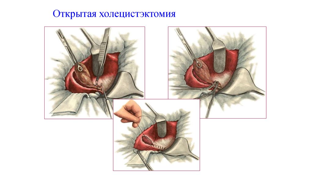 холецистэктомия открытая