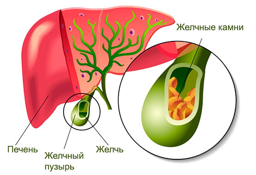 ЖКБ