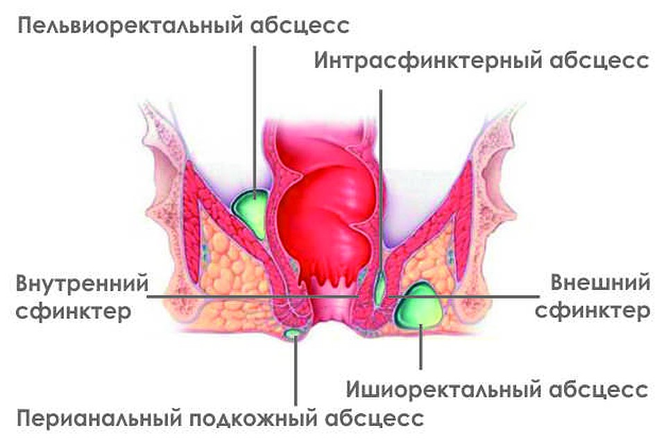 Парапроктит — гнойное воспаление параректальной клетчатки (тканей вокруг прямокишечной зоны). 