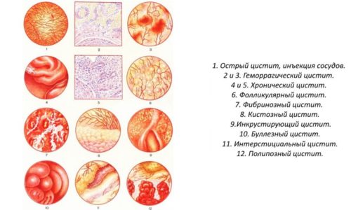 Виды цистита