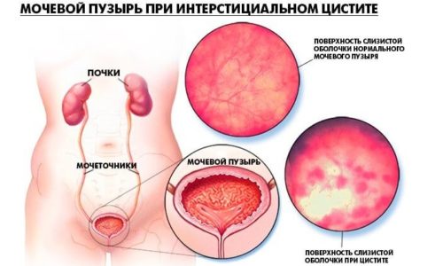 Интерстициальный цистит, сопровождающийся расстройством процесса мочеиспускания, не вызван инфекционными или вирусными агентами