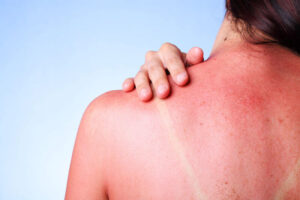 Солнечная аллергия, симптомы