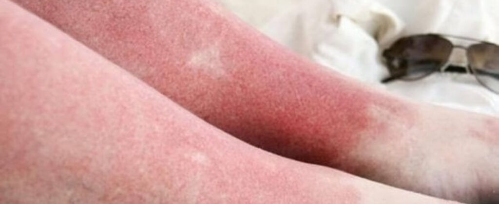 Солнечная аллергия, симптомы