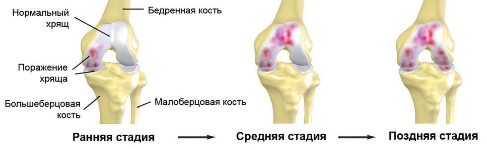 Стадии коленного артроза