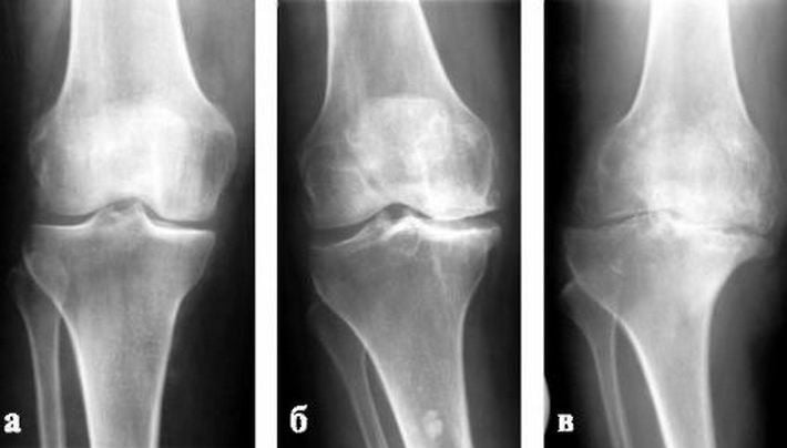 Артроз колена на рентгеновском снимке 
