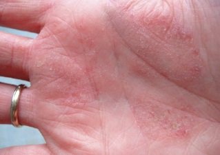 Проявление дерматита на ладони