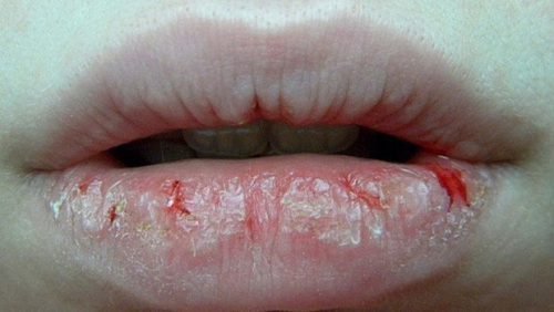 sohnut guby pochemu 500x282 - Сухость губ причины и лечение у взрослых